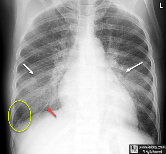 Congestive Heart Failure